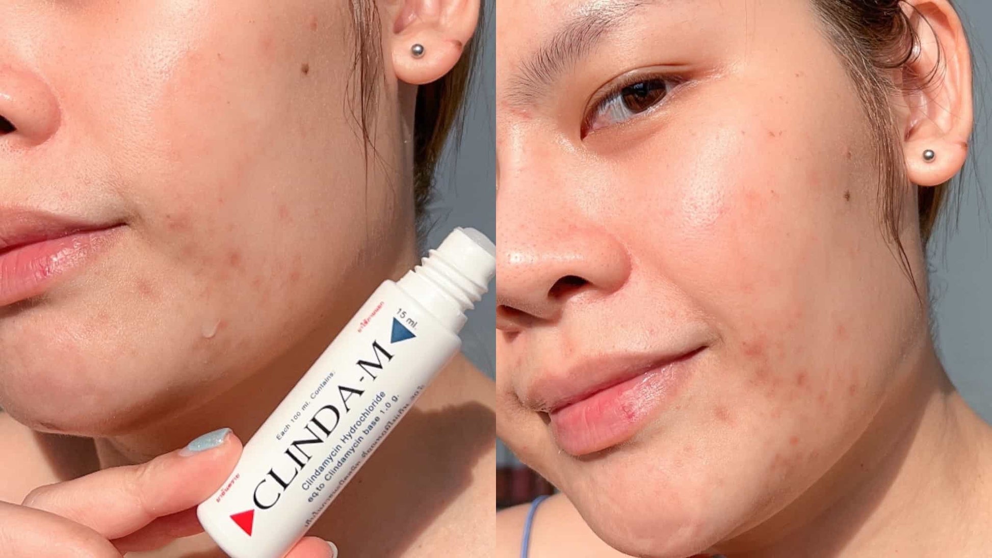  Woman applying Clinda M Acne Lotion to treat facial acne and pimples