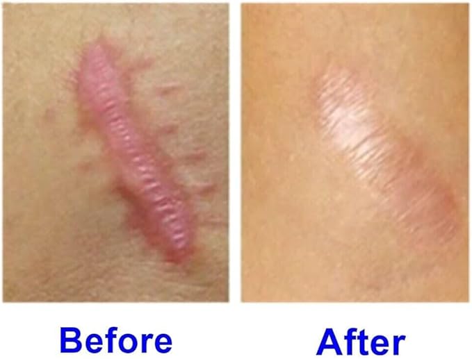 40g. HIRUDOID CREAM FOR SCARS BRUISES VARICOSE VEIN SKIN ANTI INFLAMMATION BURNS