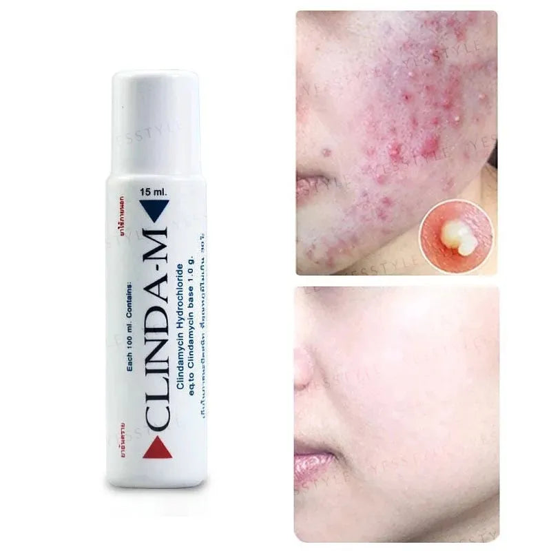  Clinda M Acne Lotion with close-up of acne-affected skin before and after treatment