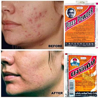Pises Powder Acne Treatment 3g x 12 Thai Herb Parachute Brand for Pimple and Scar Care