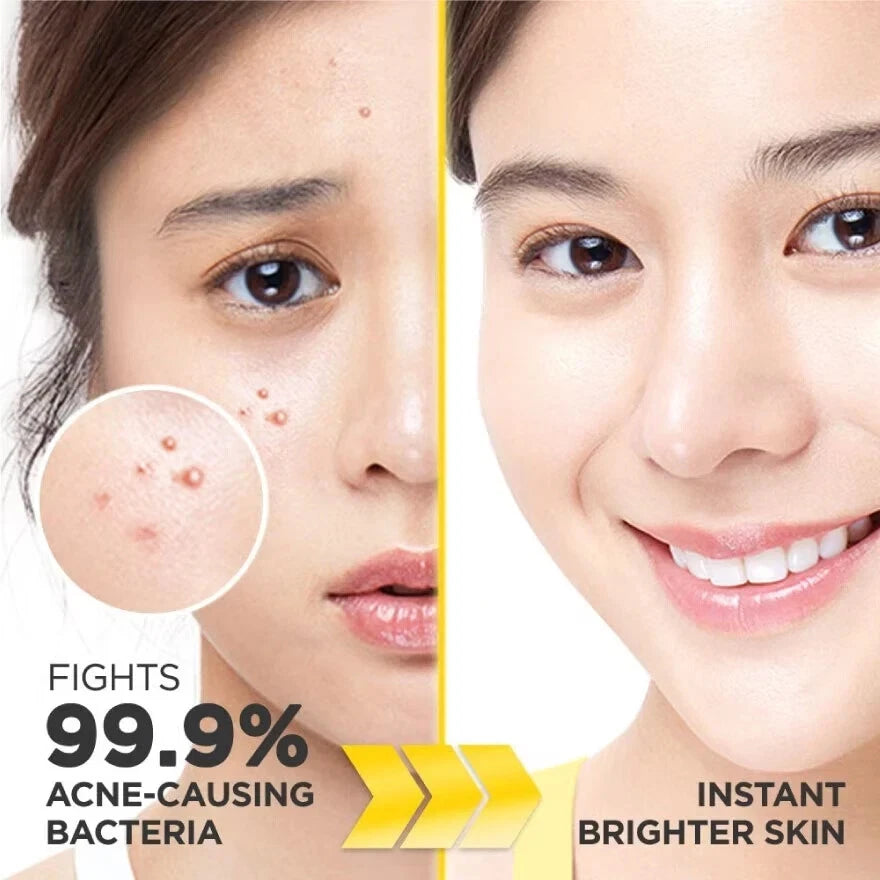 Garnier Bright Anti Acne Wash before and after skin comparison image