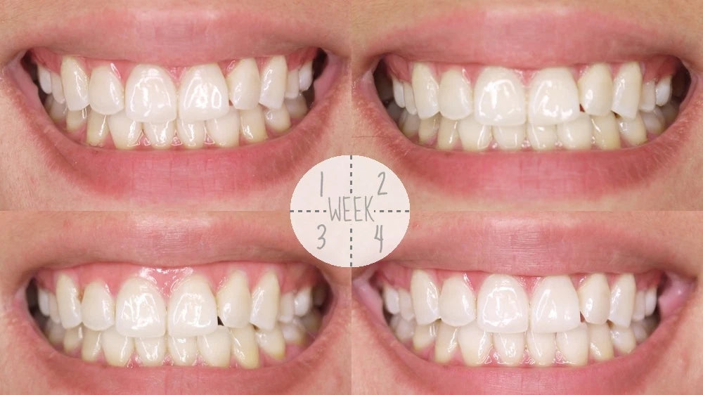 Sparkle Fresh White Toothpaste before and after white teeth comparison image
