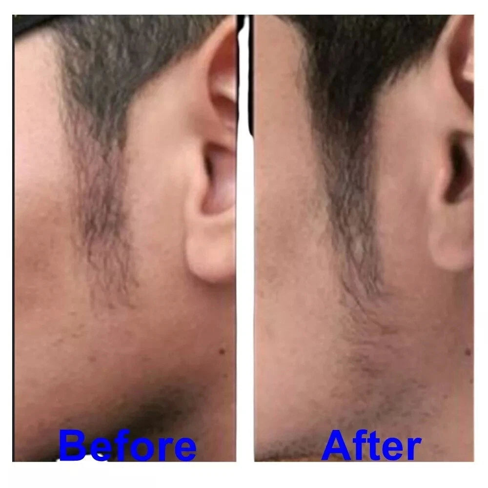 Before and after image showing facial hair growth achieved using Black Phomthong Hair Growth serum.