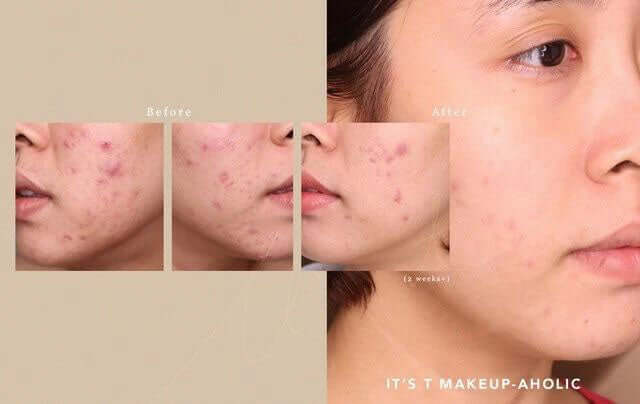 Before and after comparison showing improved skin clarity after using FYNE BHA Clarifying Serum