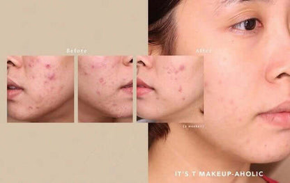 Before and after comparison showing improved skin clarity after using FYNE BHA Clarifying Serum