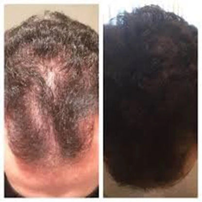 Before and after scalp photo showing reduced hair thinning and improved hair growth with Wanthai Ginseng Hair Tonic Spray