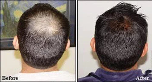 Before and after scalp treatment showing dandruff reduction and healthier scalp after using Wanthai Ginseng Hair Tonic Spray