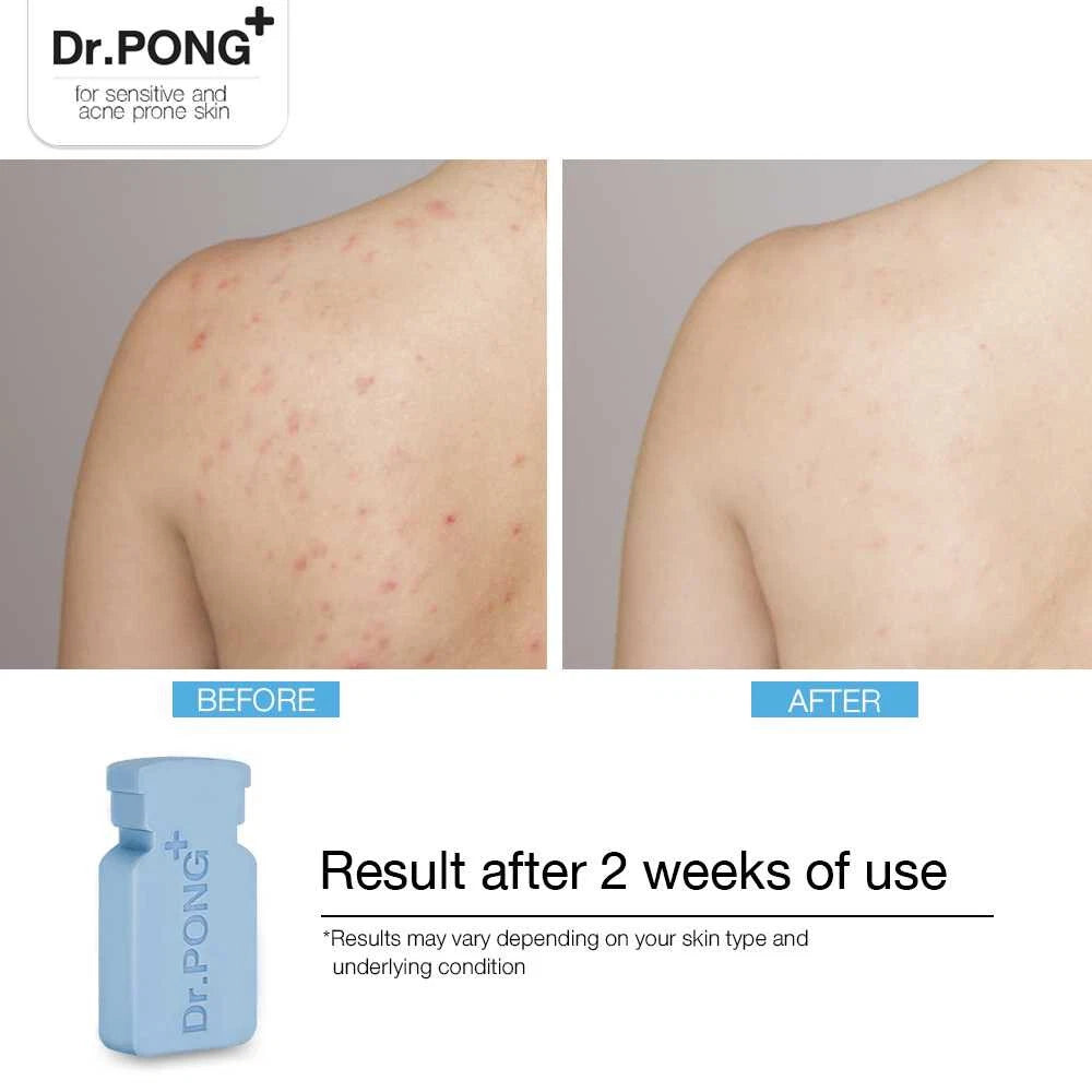 Dr.PONG Sulphur Soap suitable for shoulder and body cleansing daily use
