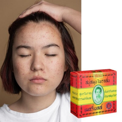 Madame Heng Merry Bell Herbal Soap box beside a young woman with acne-prone skin, promoting acne treatment and dark spot reduction.