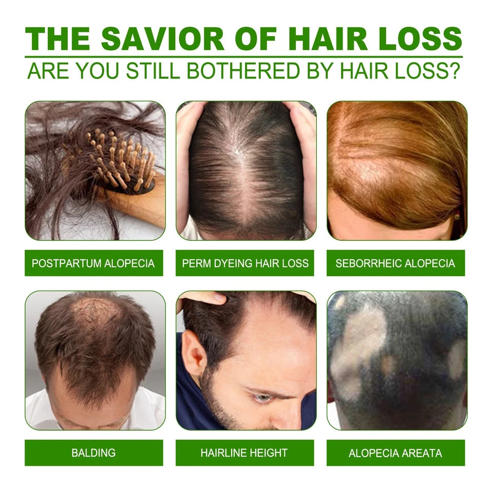 Hair loss stages diagram showing progressive thinning and baldness