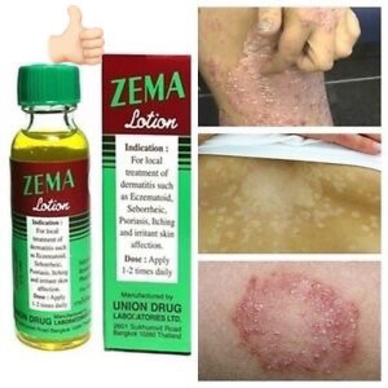Zema Lotion 15 ml next to skin showing before and after rash treatment