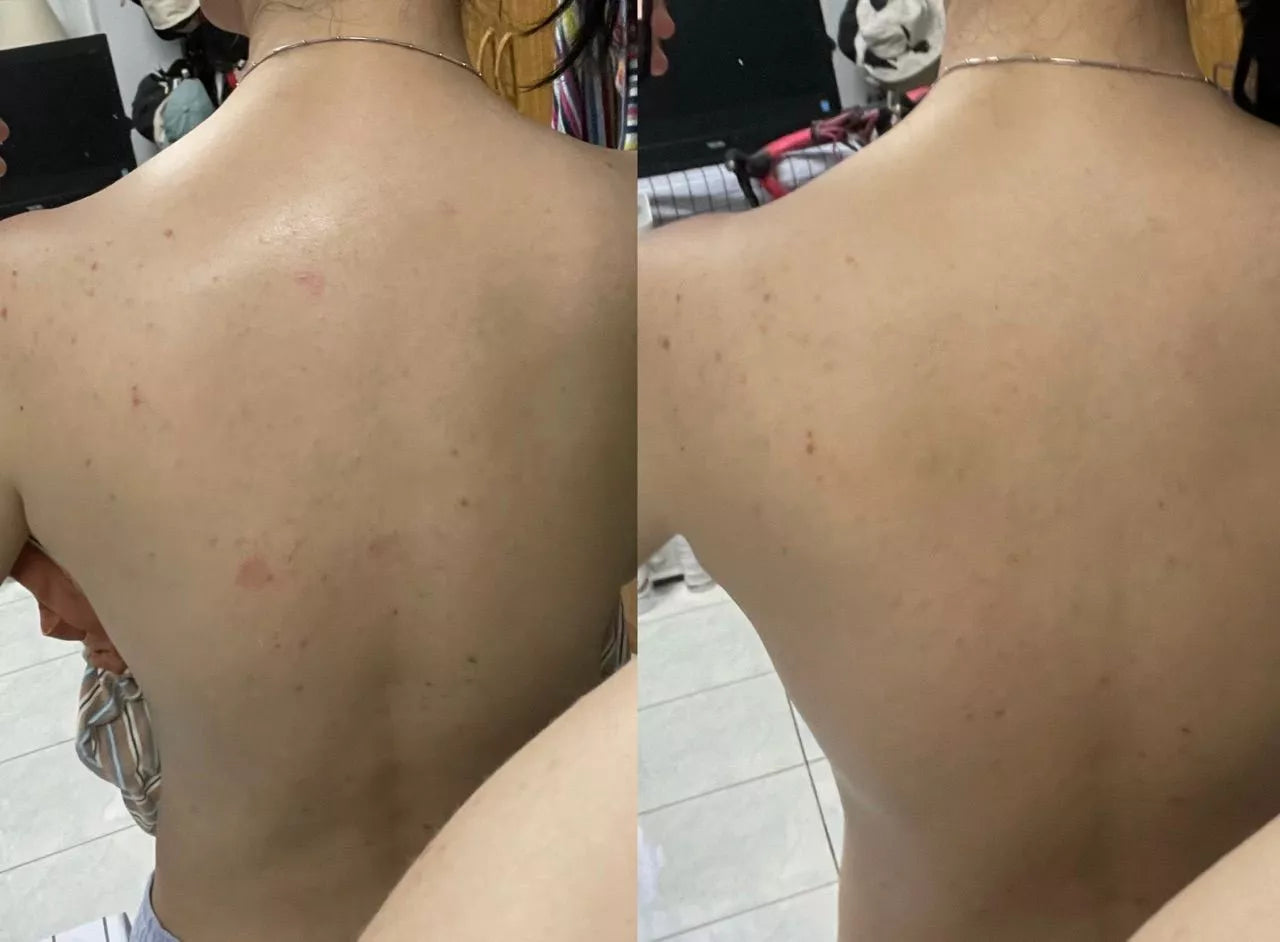 Oxe Cure Body Acne Spray before and after results on back acne skin